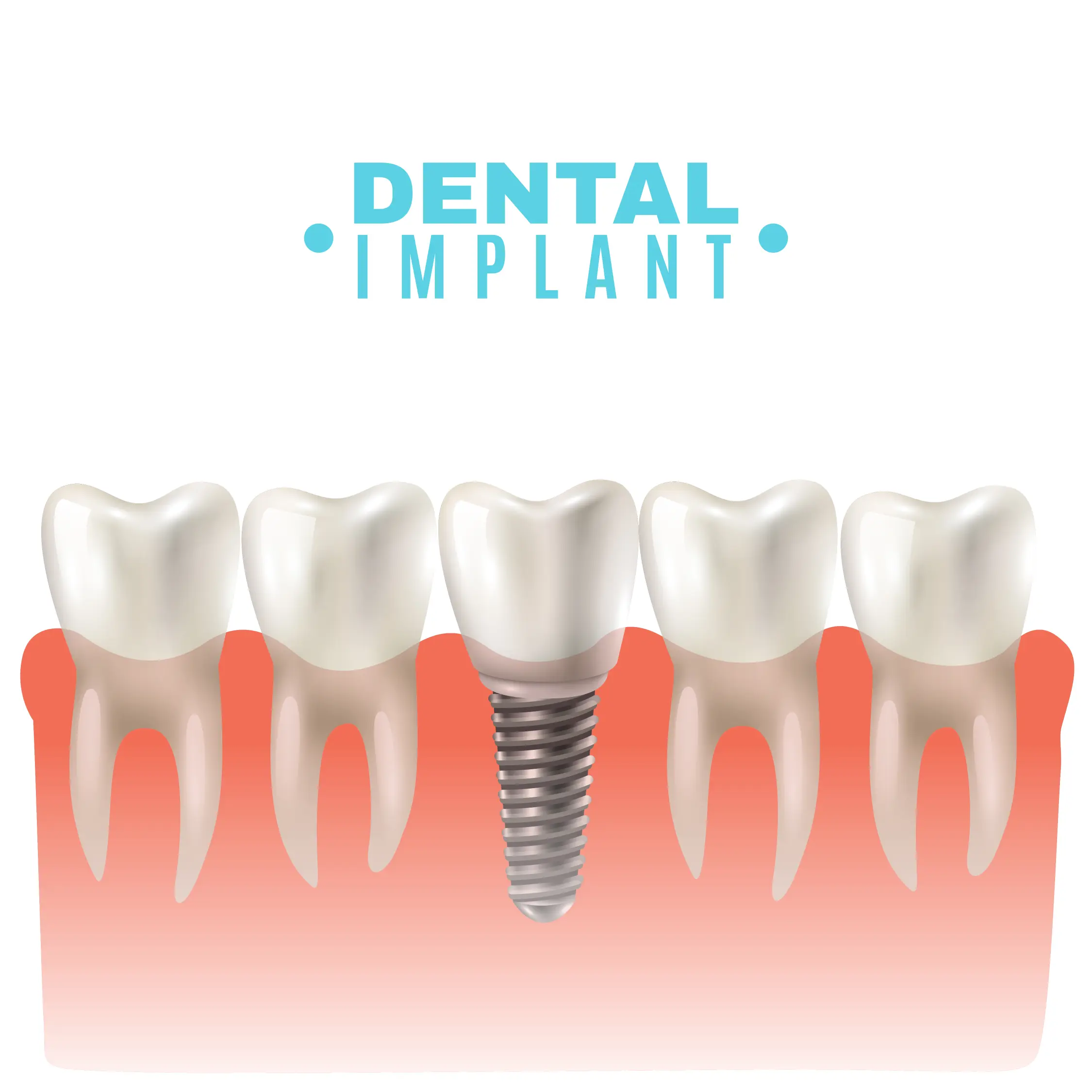 Professional dental implant at a trusted Kannur dental clinic